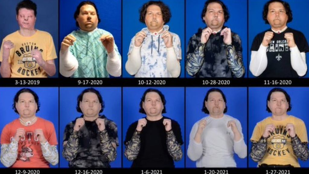 Un joven de EEUU recibe el primer trasplante de manos y rostro del mundo