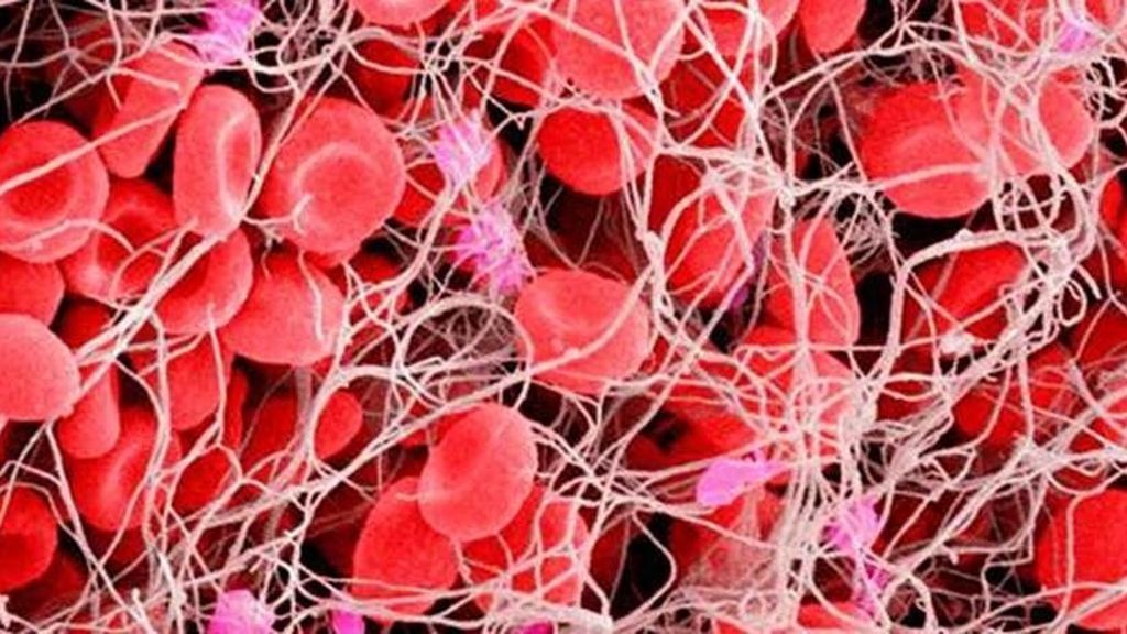 La heparina reduciría la capacidad del covid-19 para adherirse a las células humanas e infectarlas La heparina reduciría la capacidad del covid-19 para adherirse a las células humanas e infectarlas