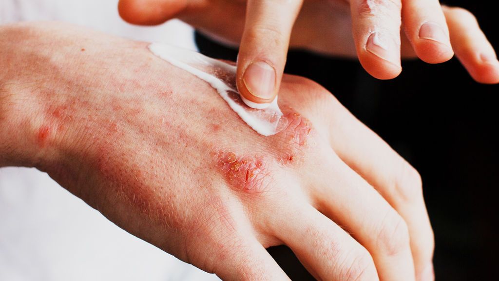 La dermatitis atópica será una de las comunes.