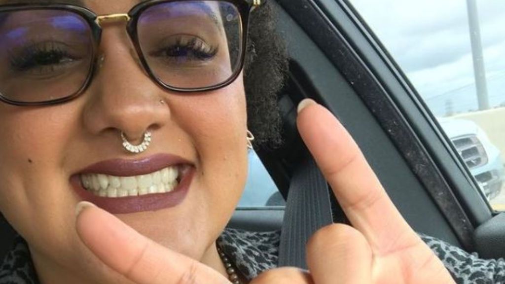 Le crece vello púbico en un dedo a causa de un injerto cuando era niña