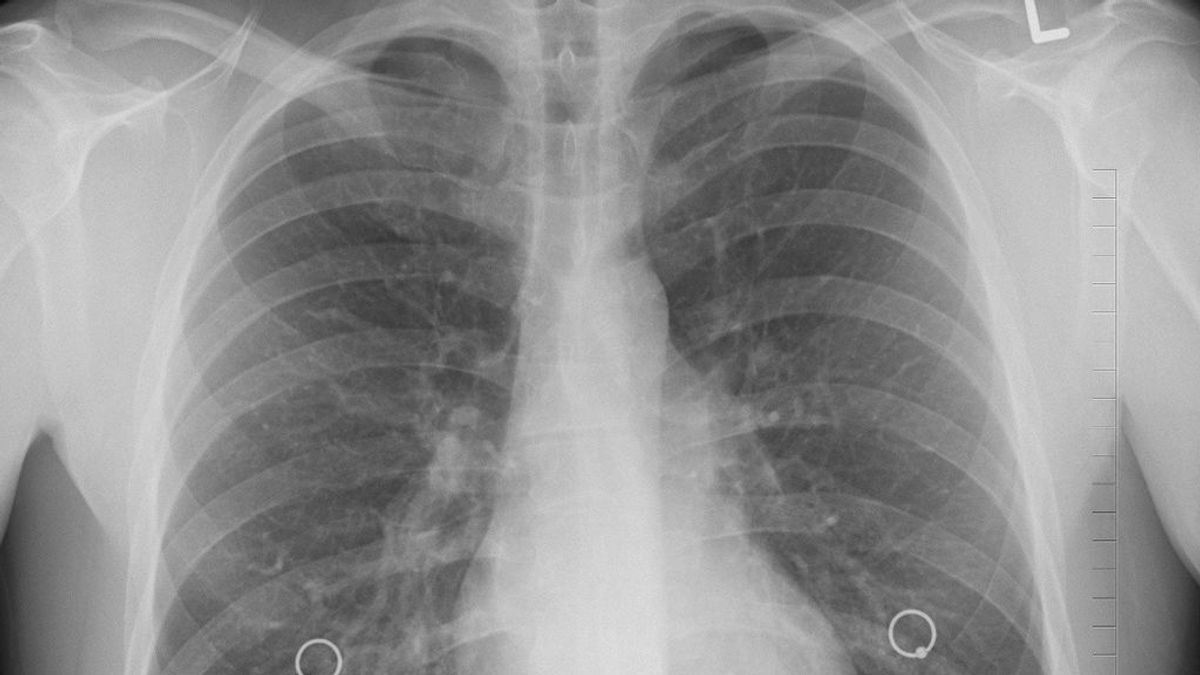 Científicos organizan un 'challenge' para detectar covid en radiografías de tórax