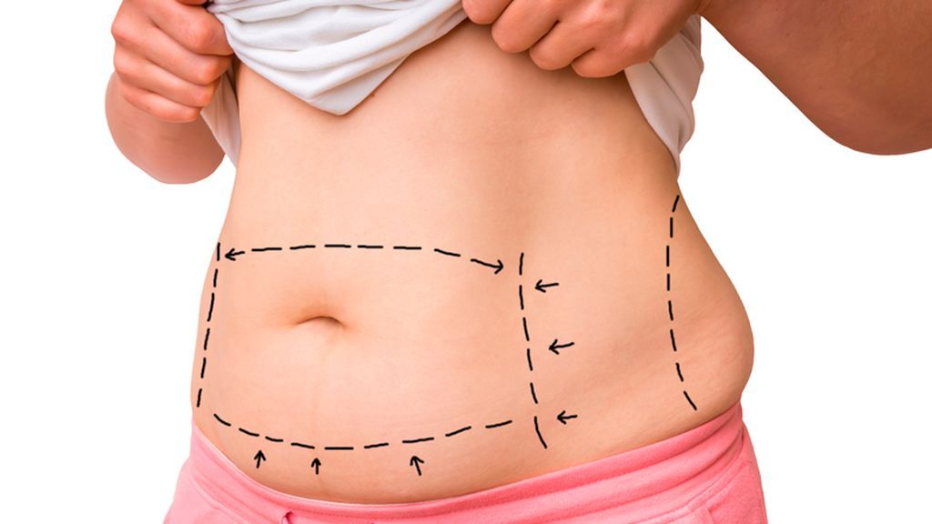 La abdominoplastia consiste en la eliminación de tejidos sobrantes en el abdomen.