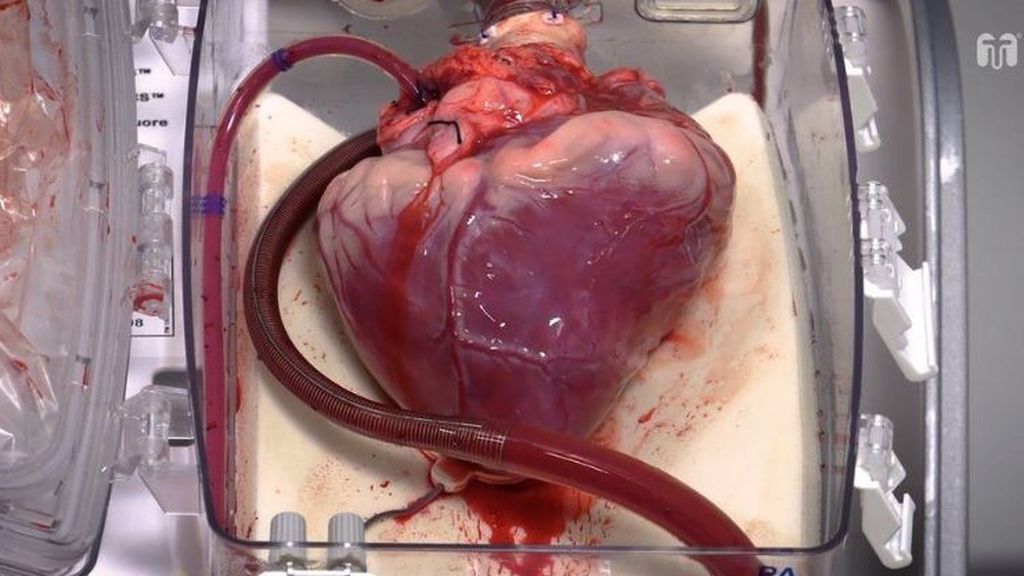 Un corazón que había dejado de latir se reanima fuera del cuerpo para ser trasplantado