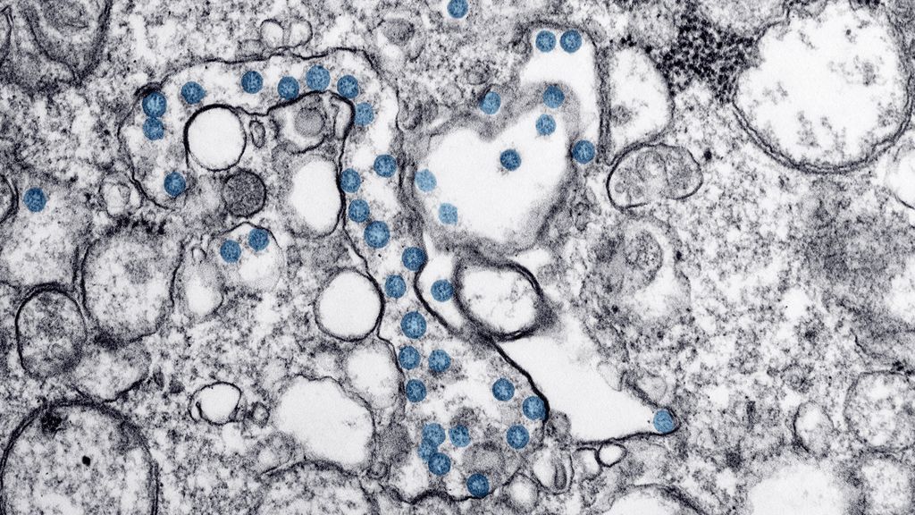 Estudios revelan que los casos graves de covid-19 tienen una predisposición genética Estudios revelan que los casos graves de covid-19 tienen una predisposición genética