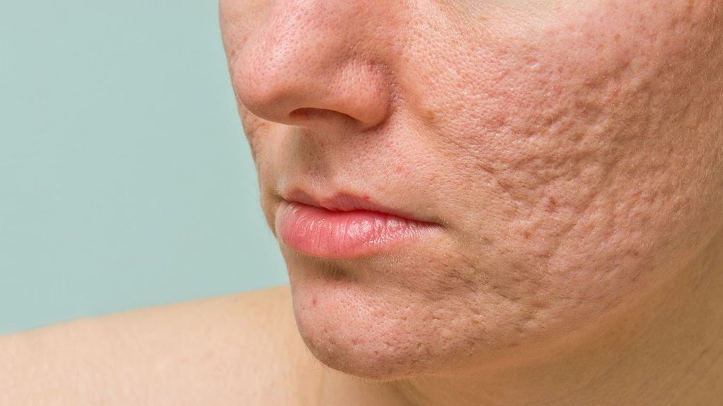 Será ideal para parar esa tendencia al acné de la piel del rostro.