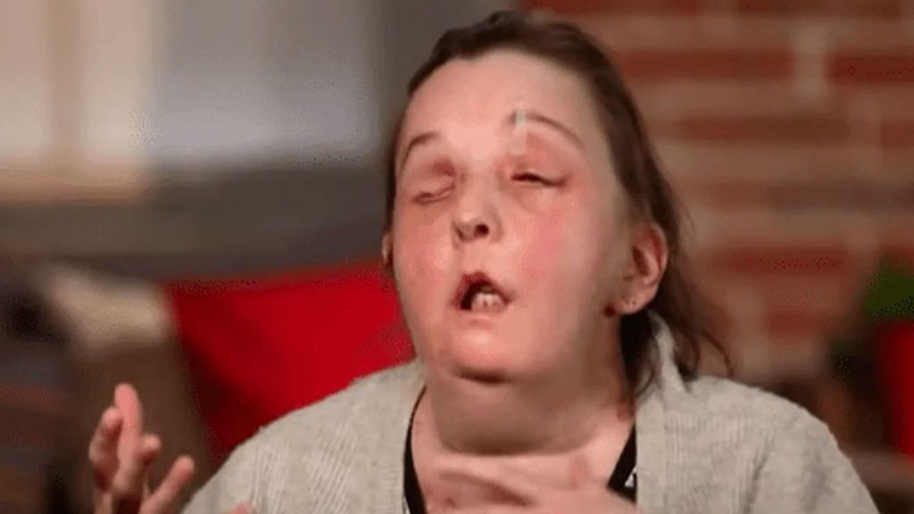 Víctima de un ataque con ácido recibe un segundo transplante facial en Estados Unidos