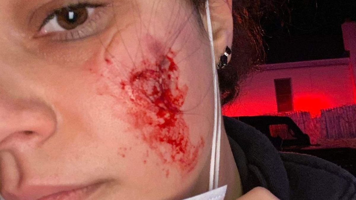 Un paciente trastornado muerde la cara a una médica que trataba de ayudarle en Brooklyn