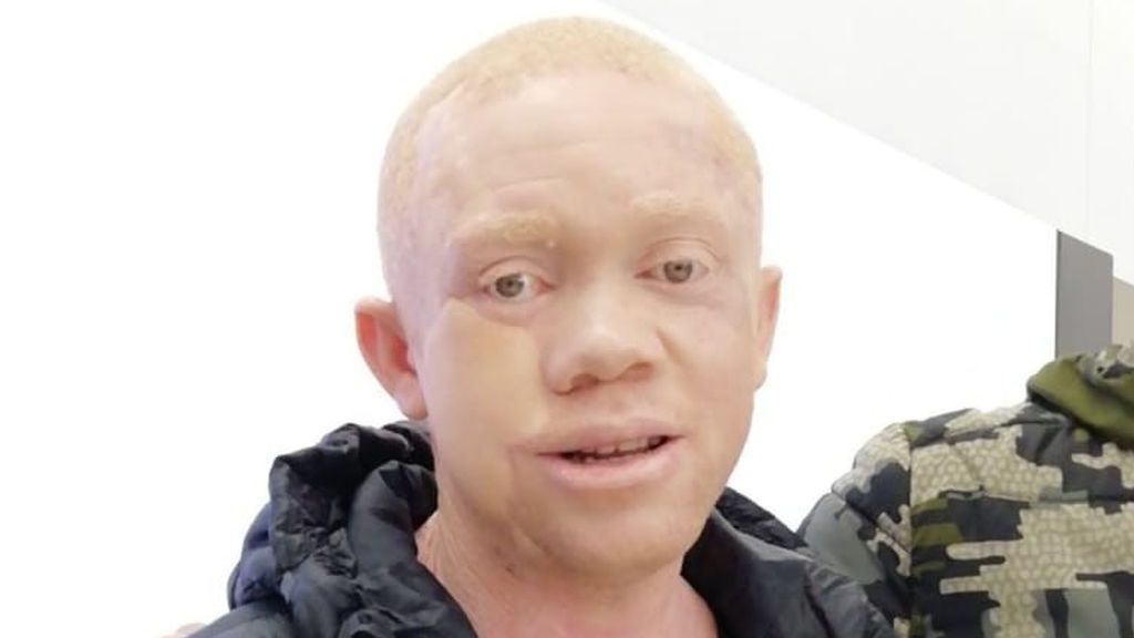 Cavadas llevó a cabo una reconstrucción facial al eliminar el tumor que Reginaldo presentaba en la cara