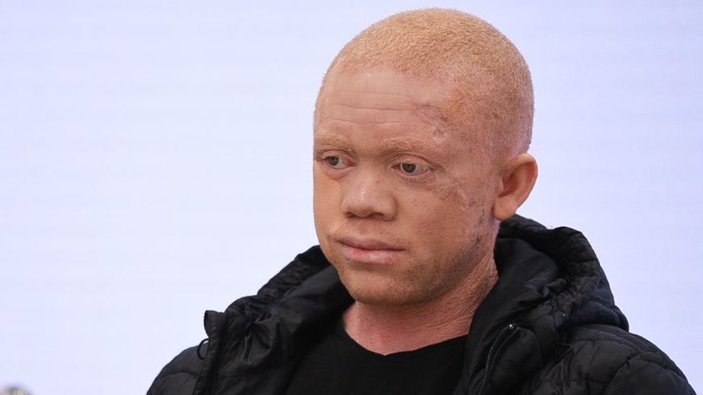 Pedro Cavadas opera con éxito a un joven negro albino con múltiples tumores en la piel