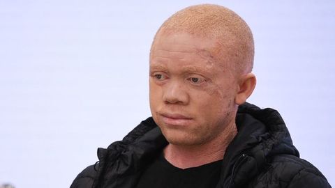 Cavadas opera con éxito a un joven negro albino con múltiples tumores en la  piel - NIUS