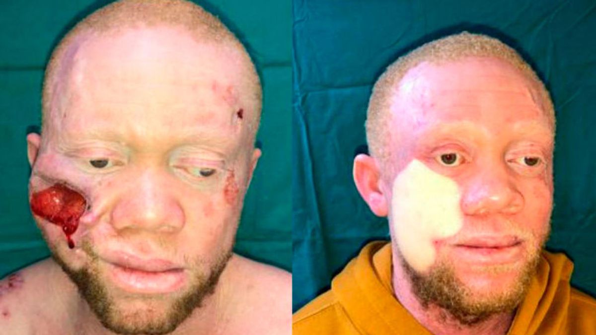 El último milagro del doctor Cavadas: reconstruye la cara de un paciente albino