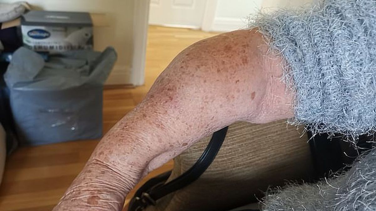 La agonía de una anciana con el brazo 18 meses tras cancelarle la operación por el covid
