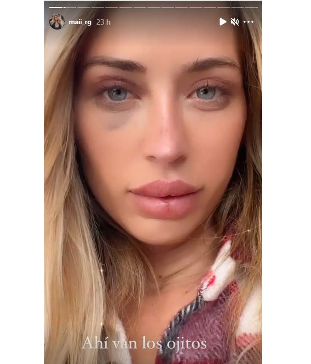 Mayka muestra cómo evolucionan sus ojos tras su intervención estética