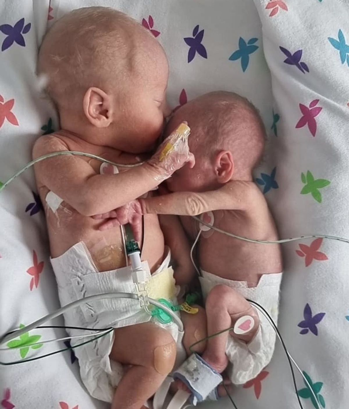 Dos bebés prematuros se abrazan por primera vez tras superar los pronósticos médicos más pesimistas