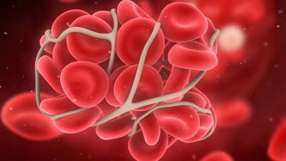 Los coágulos sanguíneos, el  covid-19 y otros cinco factores de riesgo