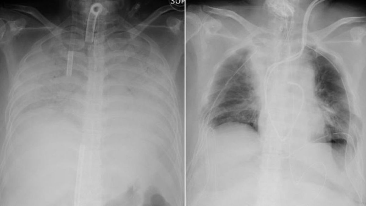 Realizan en Japón el primer trasplante de pulmón a una paciente con covid a partir de donantes vivos Realizan en Japón el primer trasplante de pulmón a una paciente con covid a partir de donantes vivos