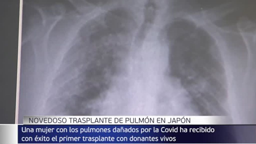 Realizan con éxito el primer trasplante de pulmón a partir de donantes vivos a una mujer en Japón