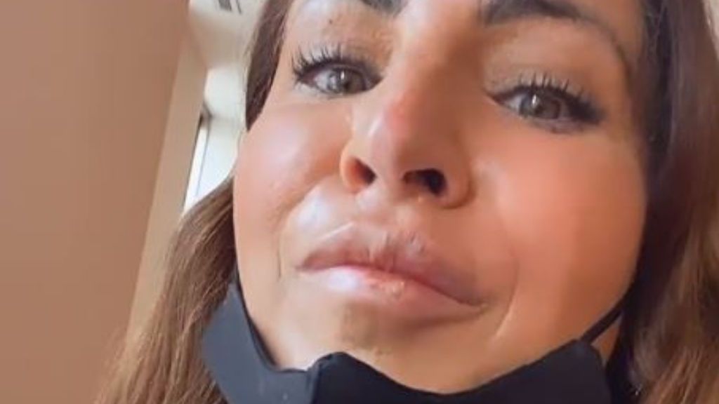 Raquel Salazar se quema los labios y la cara tras tomar una sesión de rayos uva