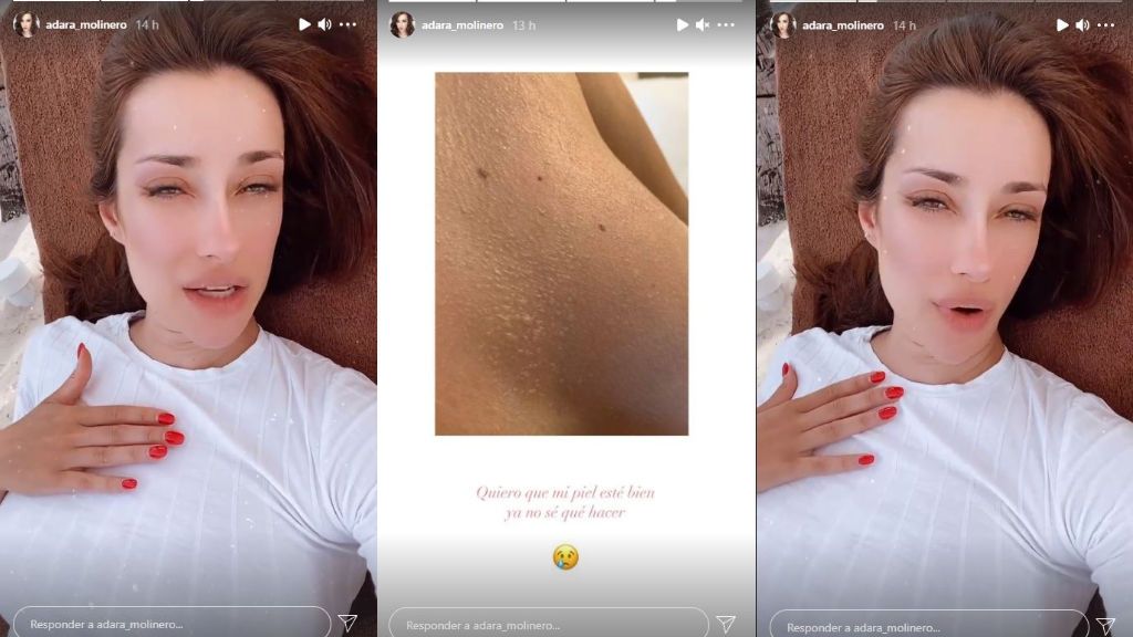 Adara, preocupada por la quemadura de su piel