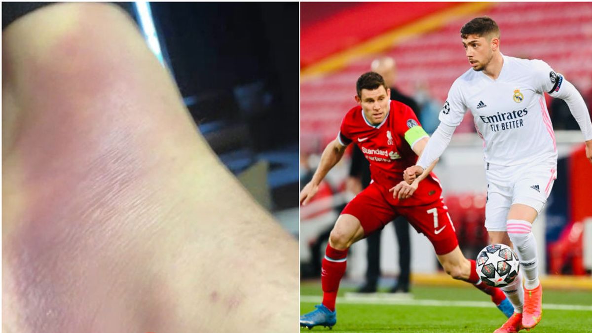 Así estaba el pie de Fede Valverde horas antes de jugar ante el Liverpool: Zidane le puso de lateral derecho por delante de Odriozola
