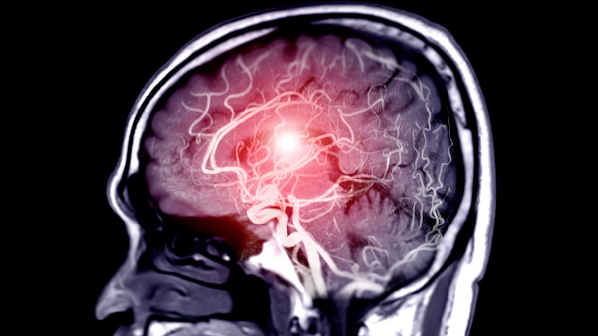 El riesgo de sufrir trombos cerebrales es 10 veces mayor al enfermar de covid que al vacunarse El riesgo de sufrir trombos cerebrales es 10 veces mayor al enfermar de covid que al vacunarse