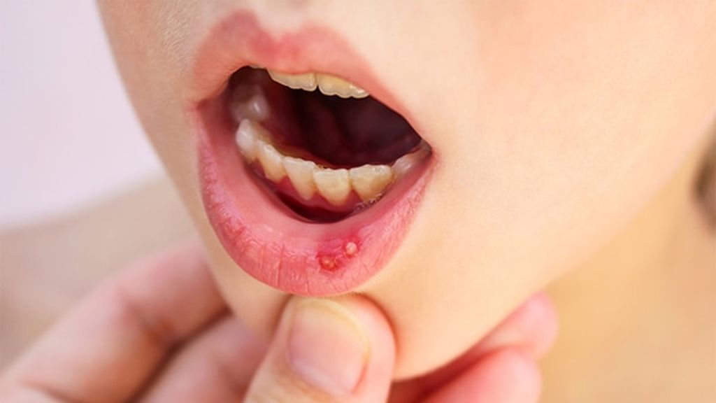 El virus mano-boca-pie es altamente contagioso.