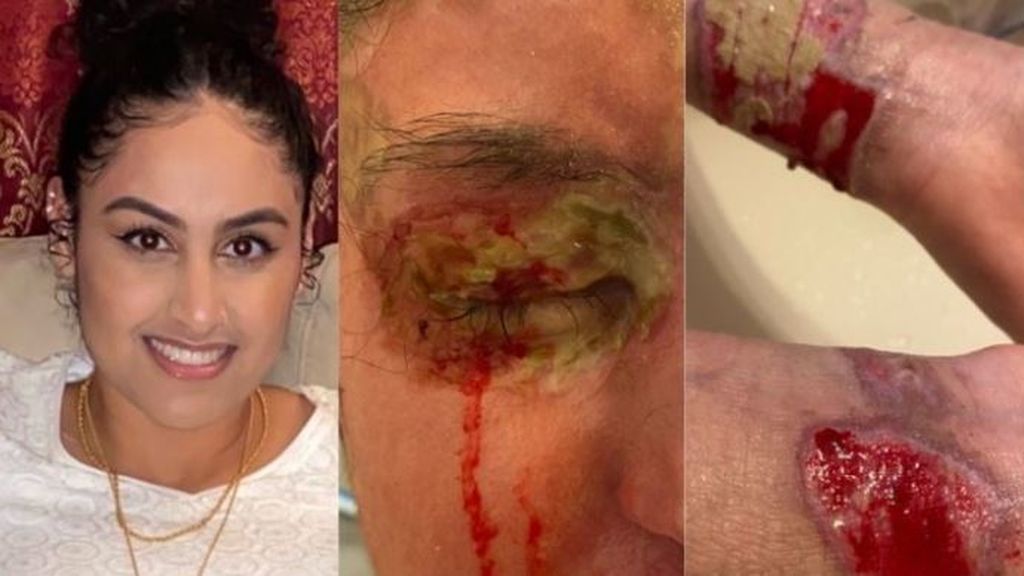 Las secuelas que dejó el ataque con ácido a Nafiah Ikram