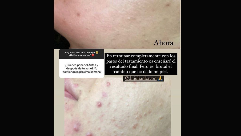 El antes y después de Susana Megan tras someterse a un tratamiento para el acné