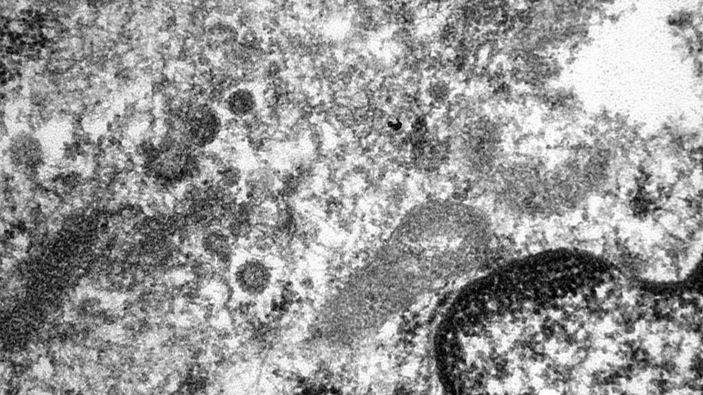 El Hospital de Mar de Barcelona fotografía el coronavirus en los vasos sanguíneos El Hospital de Mar de Barcelona fotografía el coronavirus en los vasos sanguíneos