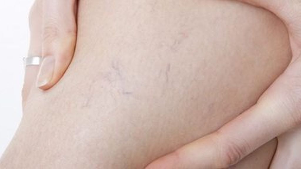 Es normal que las varices aparezcan durante el embarazo.