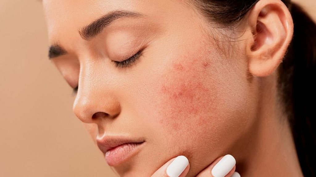 El maskné aparecerá por el uso de la mascarilla.