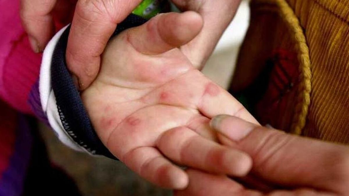 Trazan un 'mapa' de los diferentes enterovirus causantes de la enfermedad boca-mano-pie en España