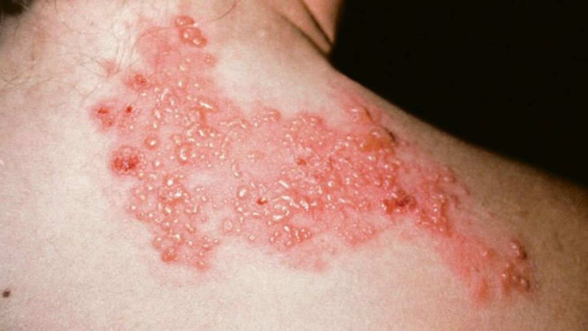El problema para diagnosticar un herpes zóster: puede confundirse con un infarto, una apendicitis o un glaucoma El problema para diagnosticar un herpes zóster: puede confundirse con un infarto, una apendicitis o un glaucoma