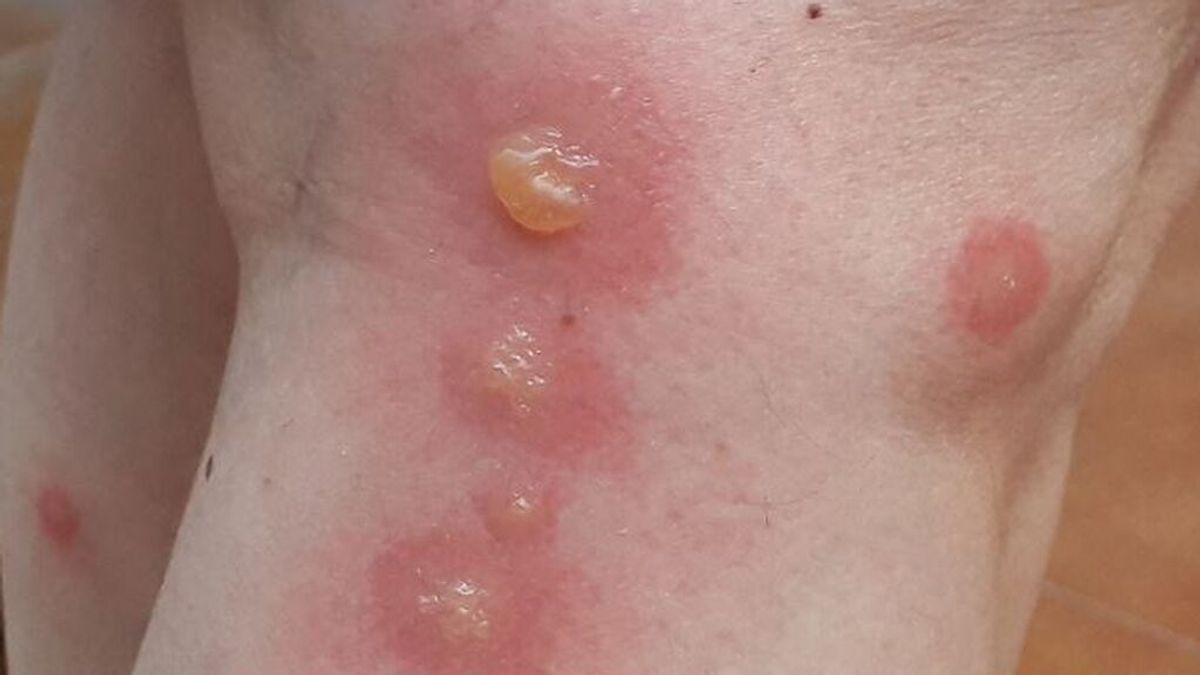 El SOS desesperado de unos vecinos de Córdoba ante los “bocados” de los mosquitos: “He tenido que ir a Urgencias” El SOS desesperado de unos vecinos de Córdoba ante los “bocados” de los mosquitos: “He tenido que ir a Urgencias”