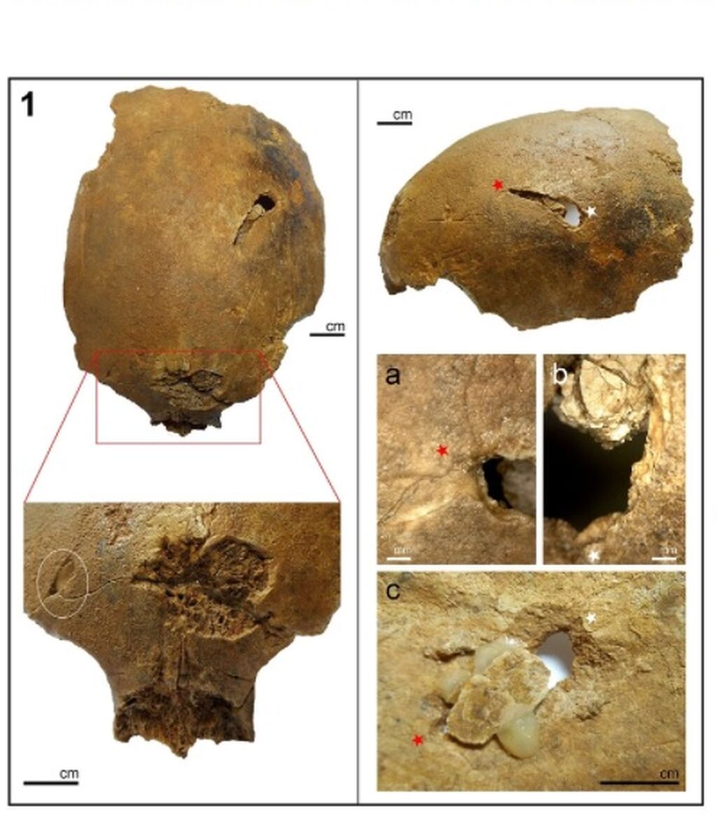 Lesiones en los cadáveres de Jebel Sahaba