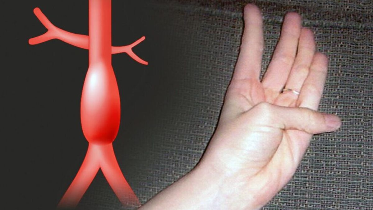 Un simple movimiento de dedo podría indicar el riesgo de sufrir un aneurisma aórtico