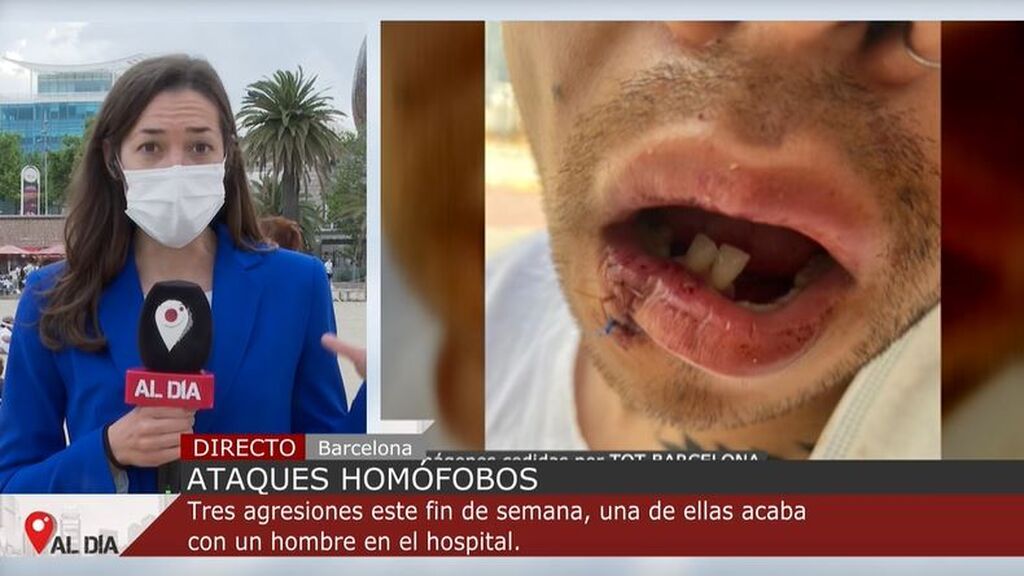 Un joven, operado en Barcelona tras agresión homófoba múltiple en playa