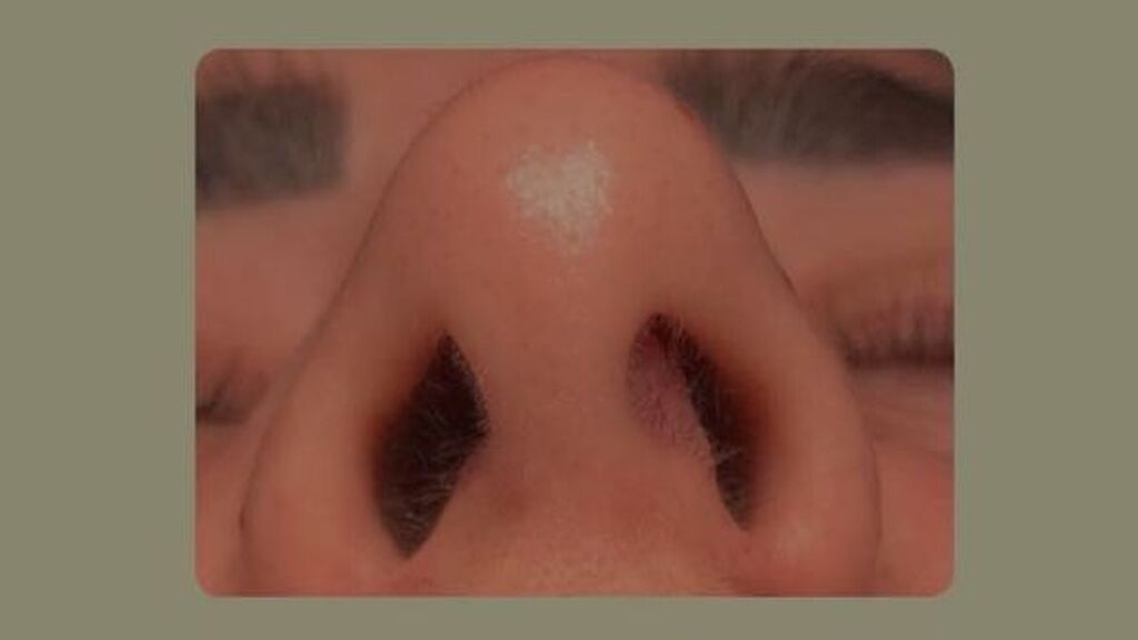 Así era la nariz de Marina antes de someterse a una rinoplastia