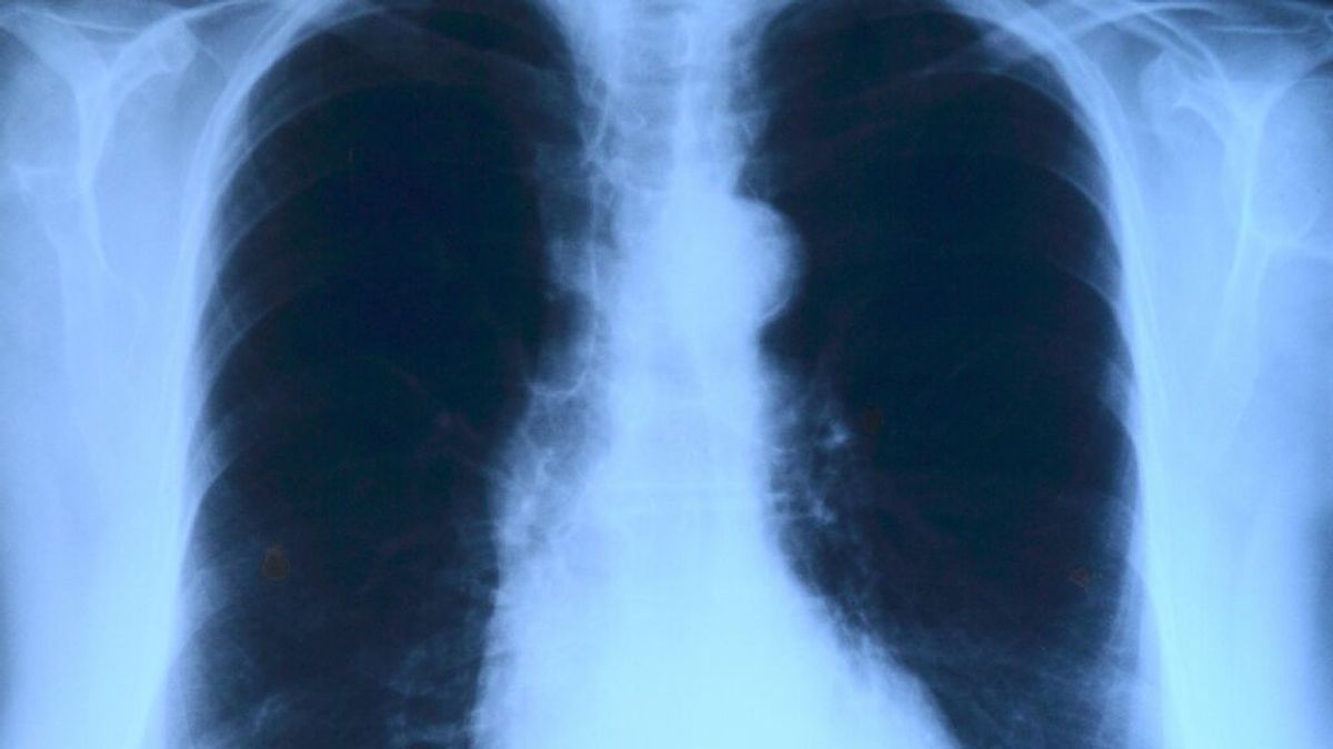 ¿Qué es un edema pulmonar?: los síntomas y las causas que lo provocan