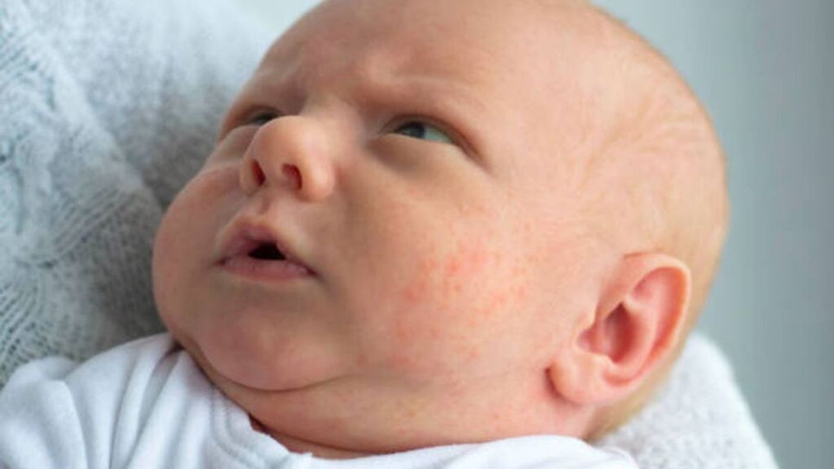 Qué es y cómo se cura un eritema tóxico en bebés nacidos: todo lo que debes saber.