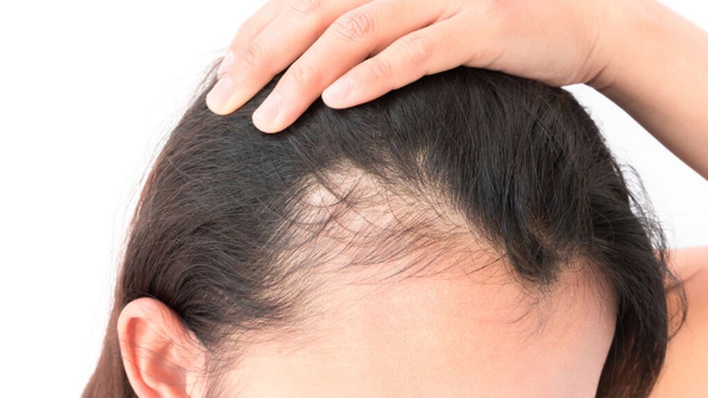 Tras el parto es más normal que el pelo se caiga con más frecuencia.