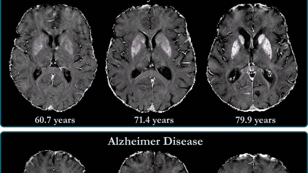 Las proteínas inflamatorias pueden ralentizar el deterioro cognitivo en ancianos, según estudio