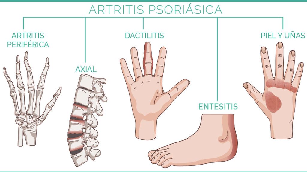 artritis