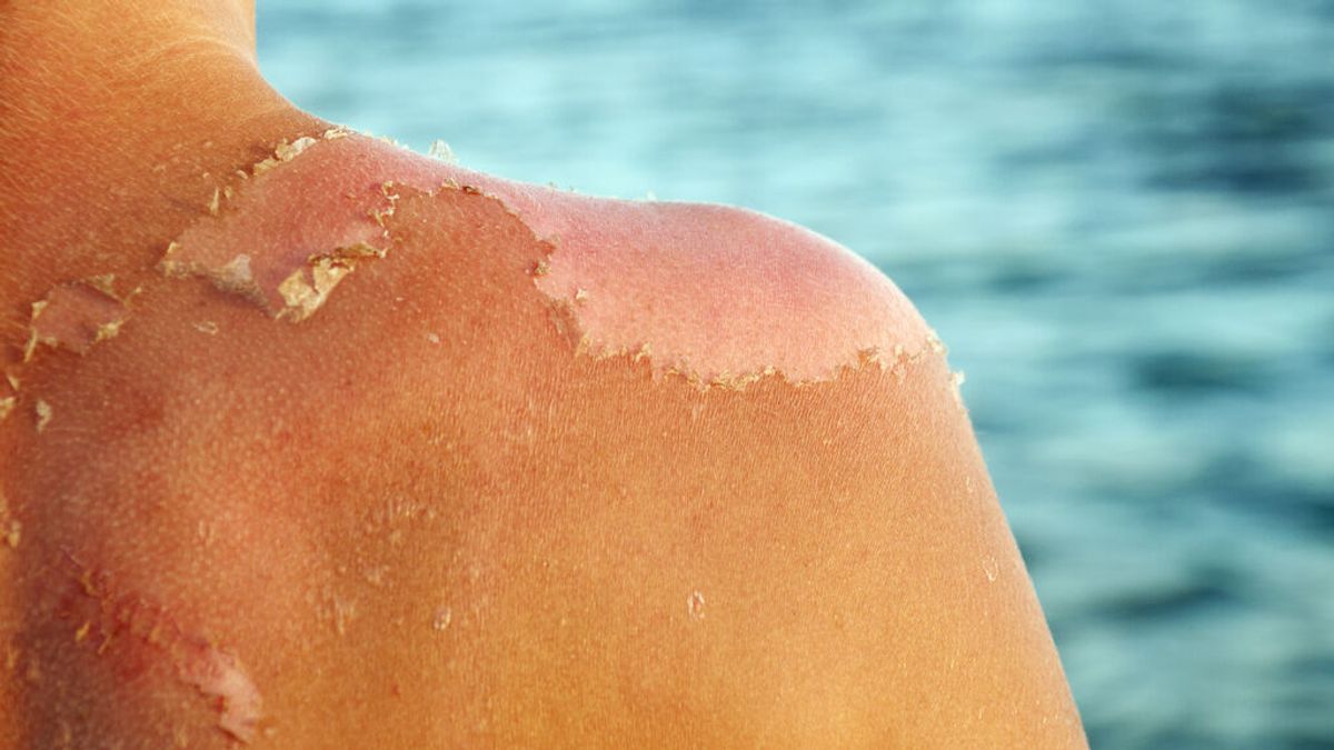Qué hacer si se te pela la piel después de tomar el sol