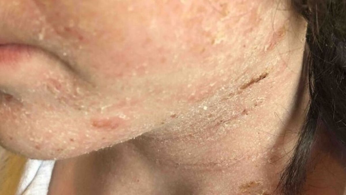 Un niño con un eccema severo pide entrar en coma inducido para no tener que soportar el dolor Un niño con un eccema severo pide entrar en coma inducido para no tener que soportar el dolor