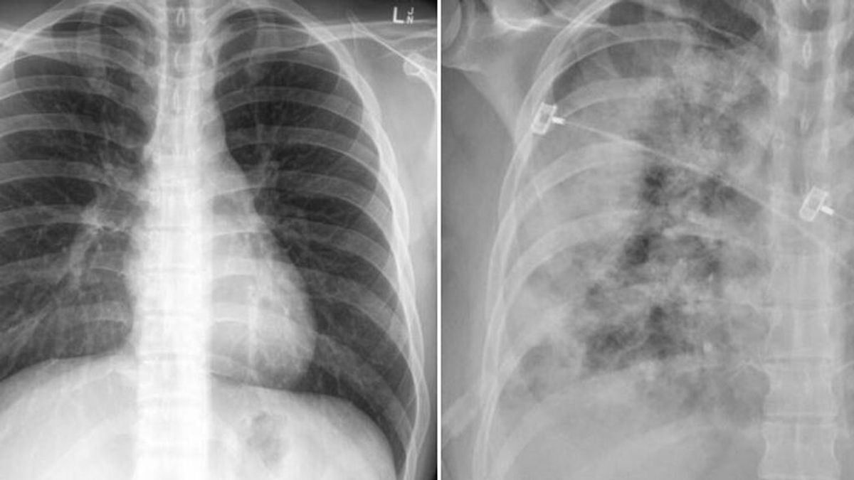 La radiografía del doctor Faheem Younus que demuestra cómo las vacuna nos protegen aunque nos contagiemos