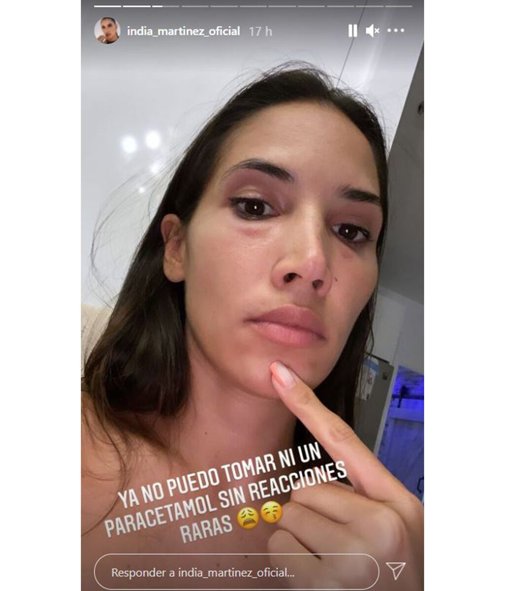India Martínez sufre una fuerte reacción alérgica