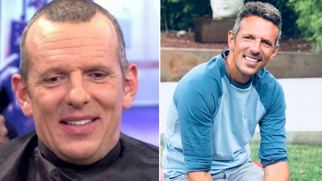 El antes y después de Joaquín Prat tras su injerto de pelo