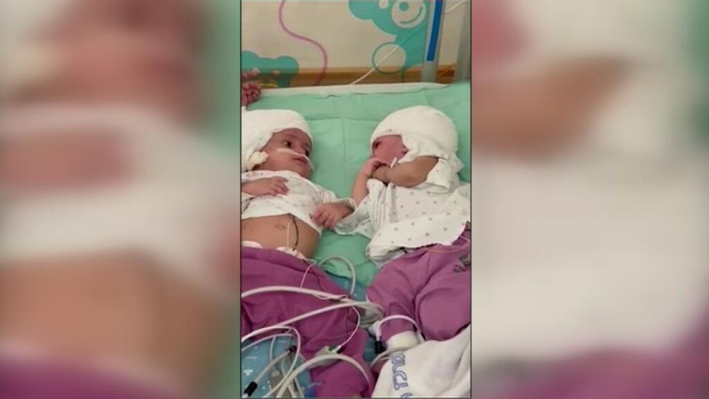 Dos bebés siamesas pueden por fin mirarse a la cara tras una operación de 12 horas en Israel