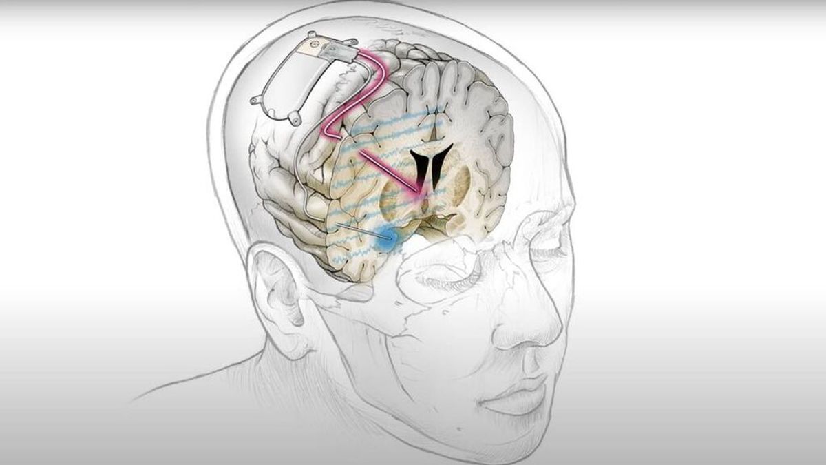 Científicos desarrollan un marcapasos cerebral que ayuda a curar la depresión severa